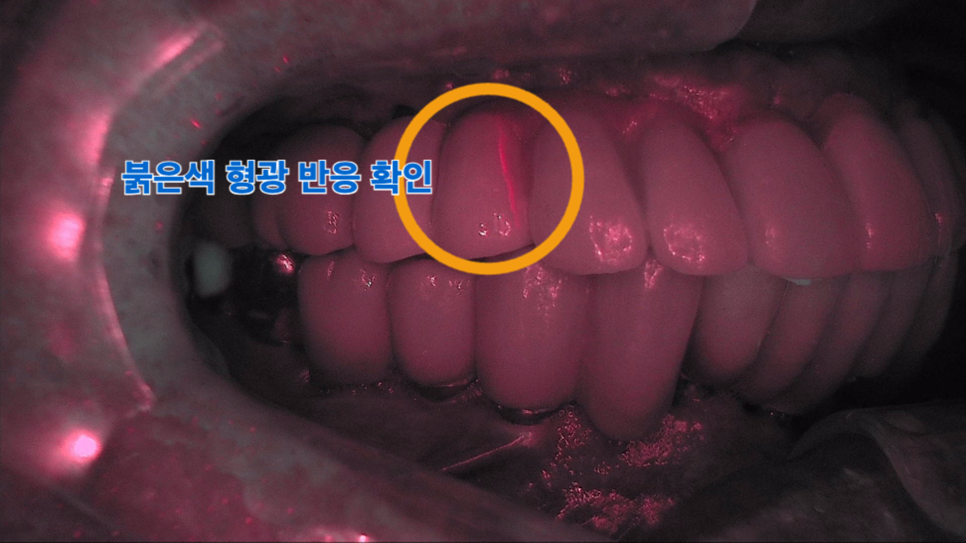 큐레이캠 장비를 통해 붉은색 형광 반응으로 관찰된 미세 균열