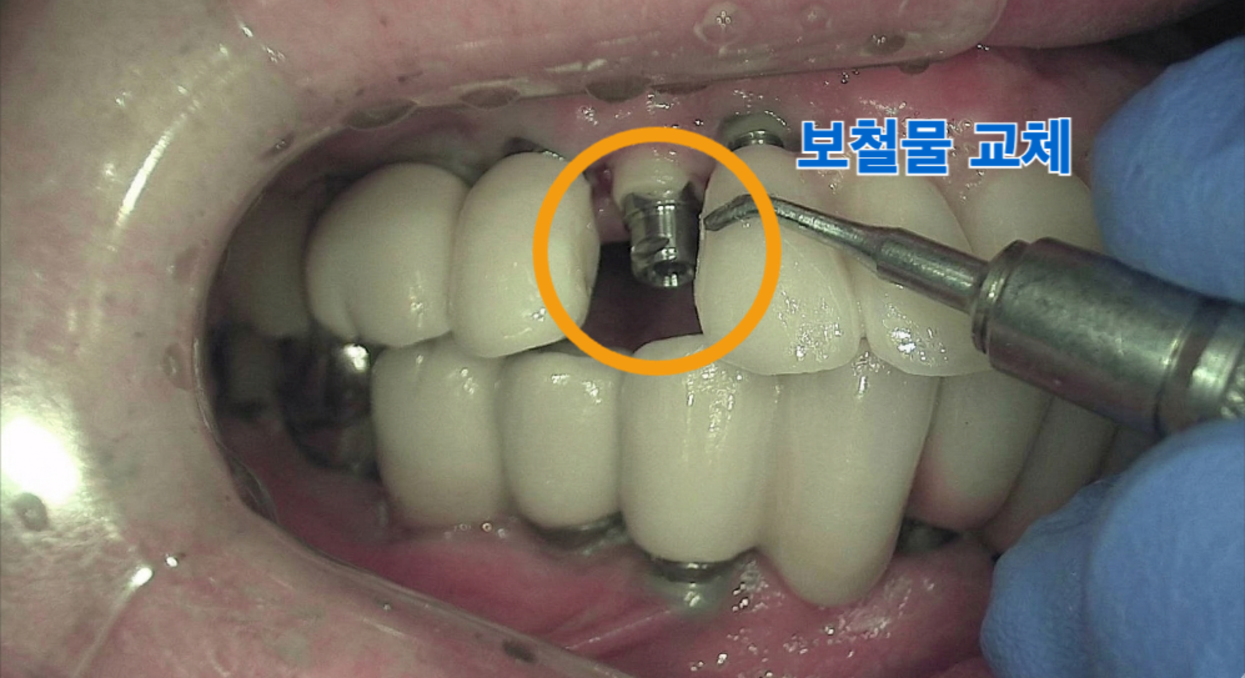 손상된 기존 임플란트 보철물 철거 및 교체 준비 과정