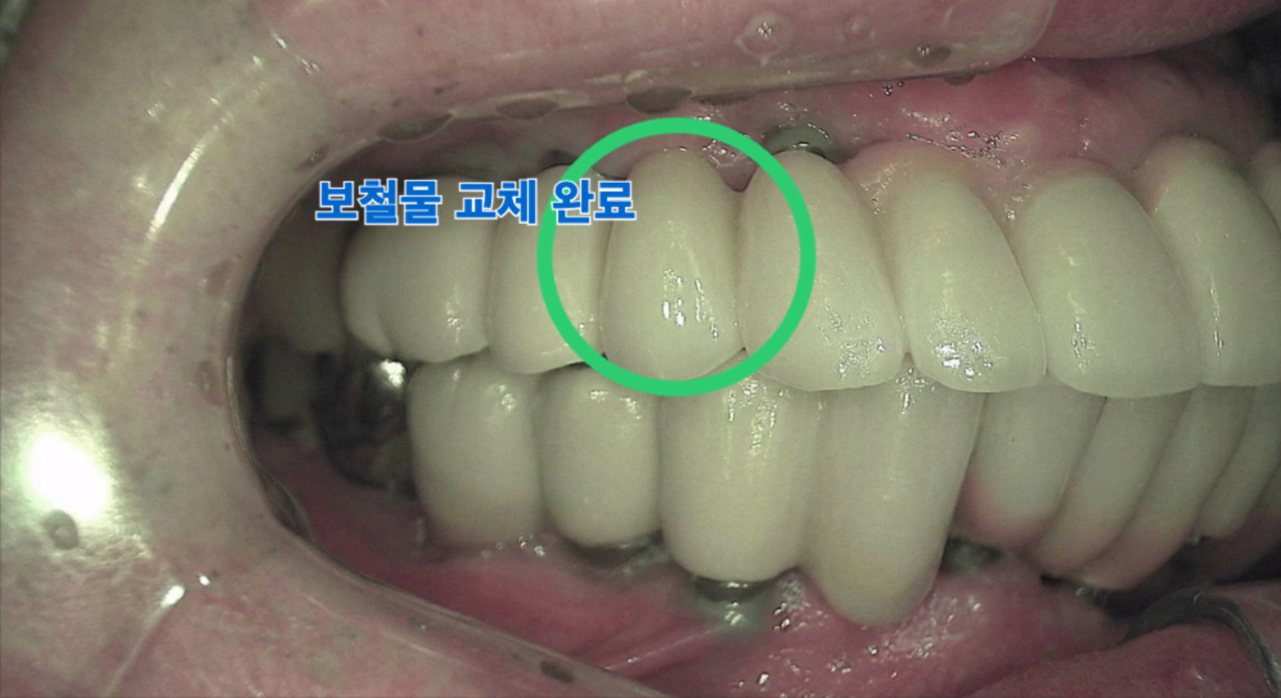 새로운 임플란트 보철물로 성공적으로 교체가 완료된 모습