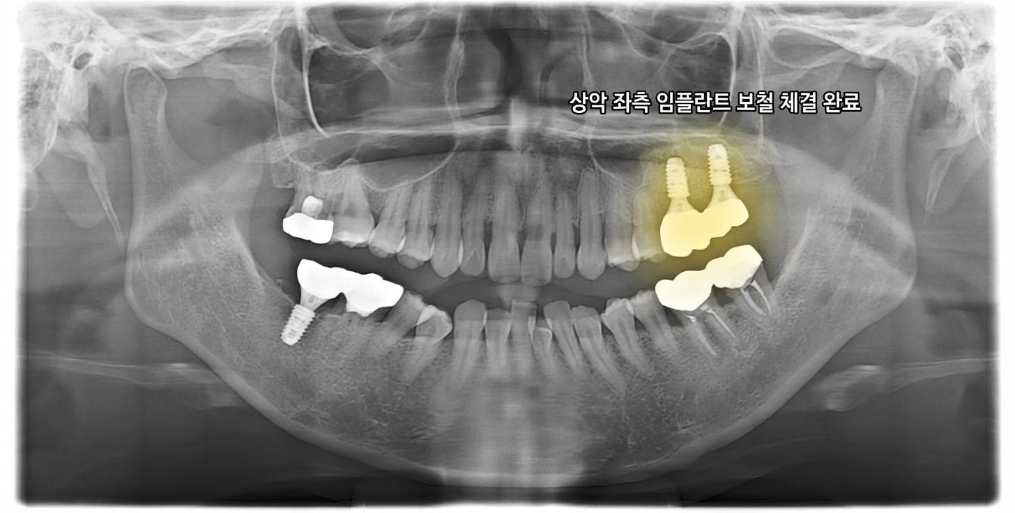 임플란트 보철 체결 직후