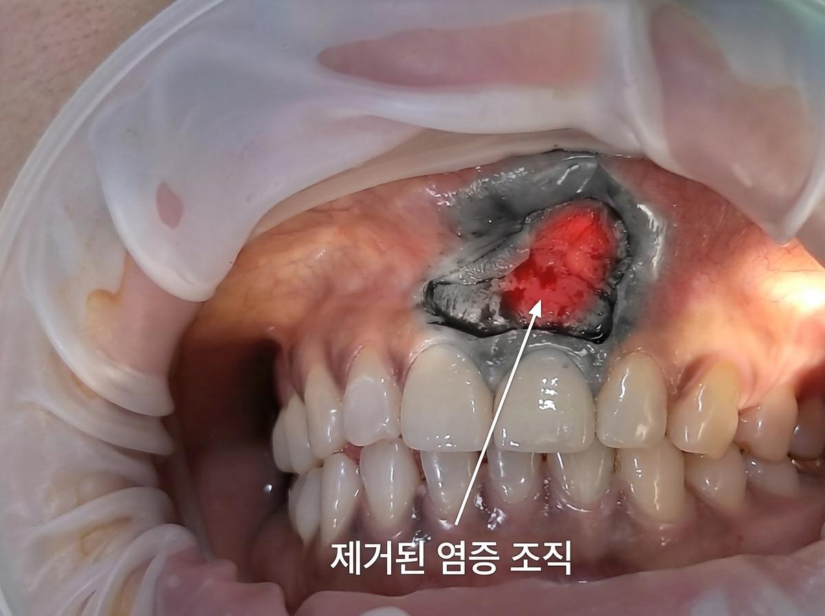 치근단 절제술 중간에 21번 염증사진