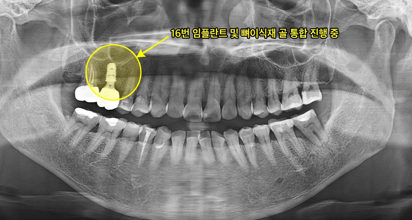보철물 장착 후 파노라마 X-ray 사진