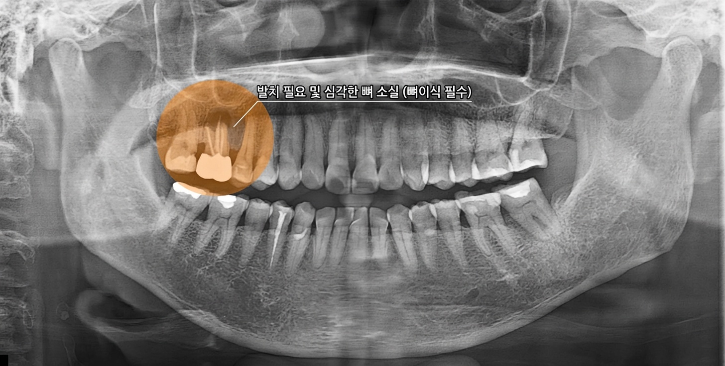 초진 파노라마 X-ray 사진