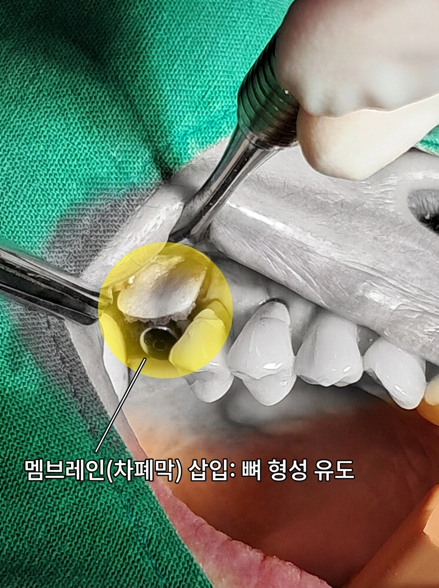 수술 중 차폐막 삽입 사진