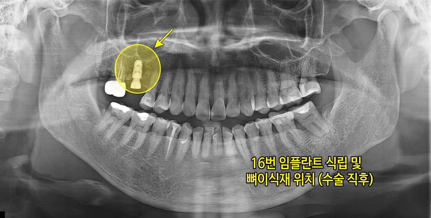 임플란트 수술 직후 X-ray 사진