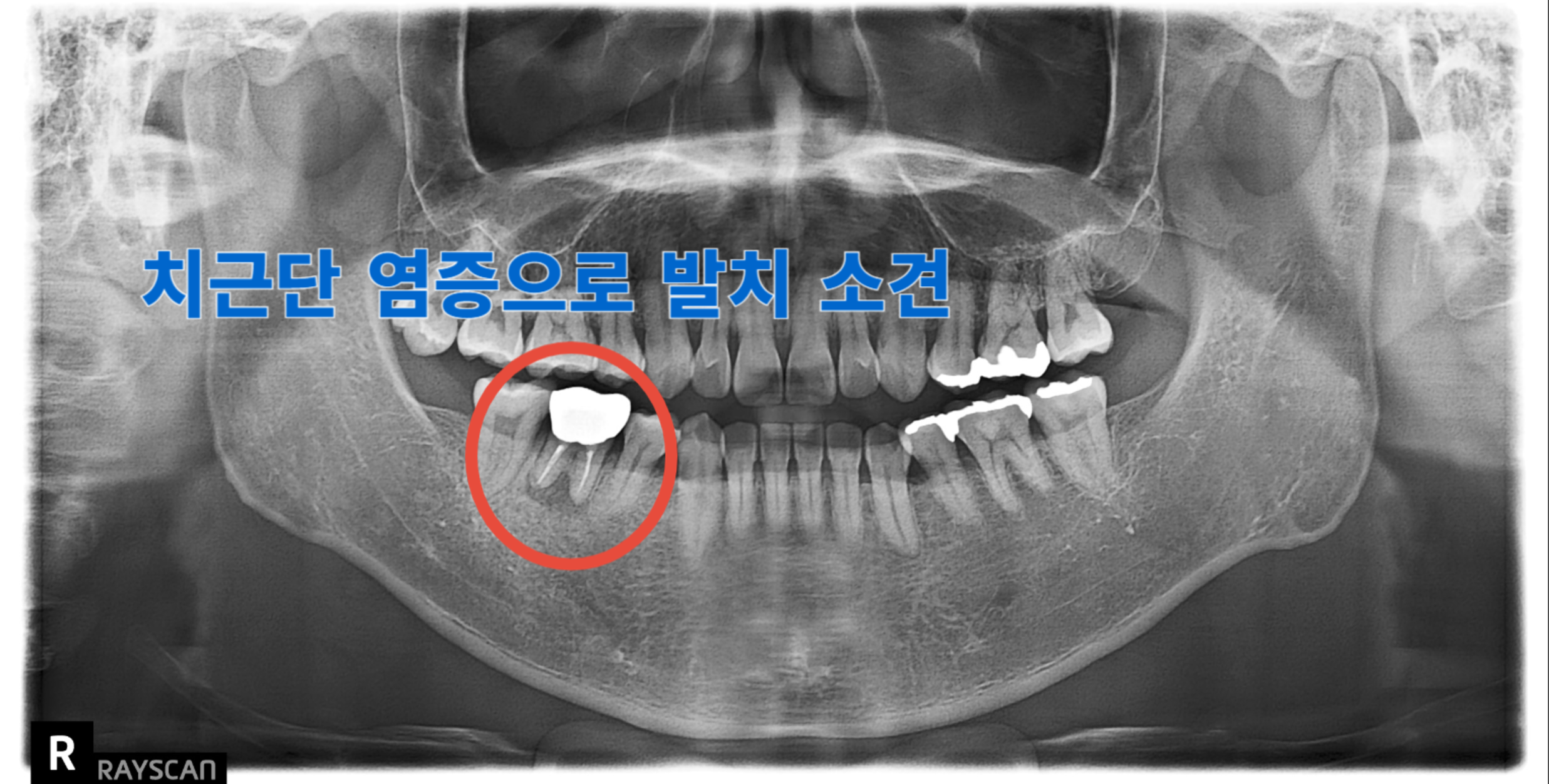 [치료 전] 하악 우측 어금니(#46) 상실 후 임플란트 시술 전 파노라마 사진입니다.