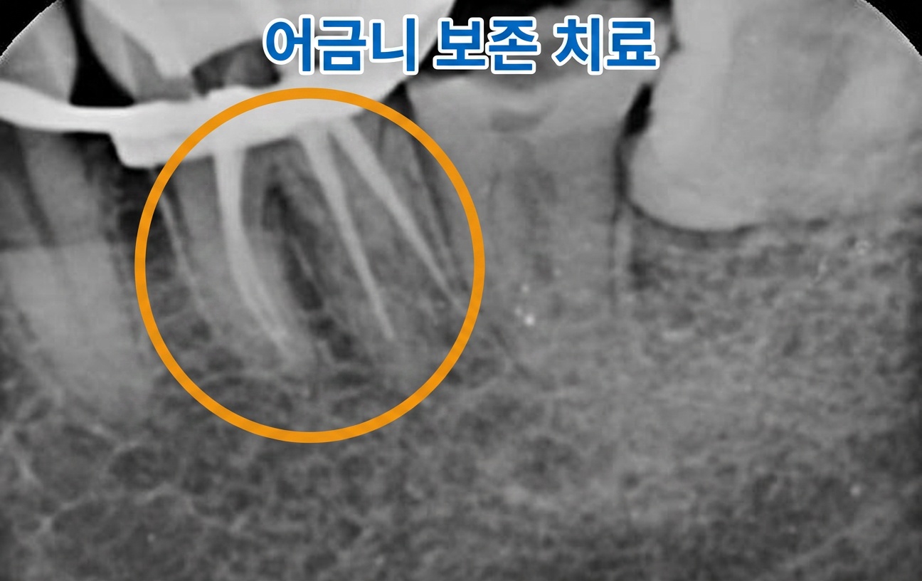 [치료 중] 치아파절 신경치료