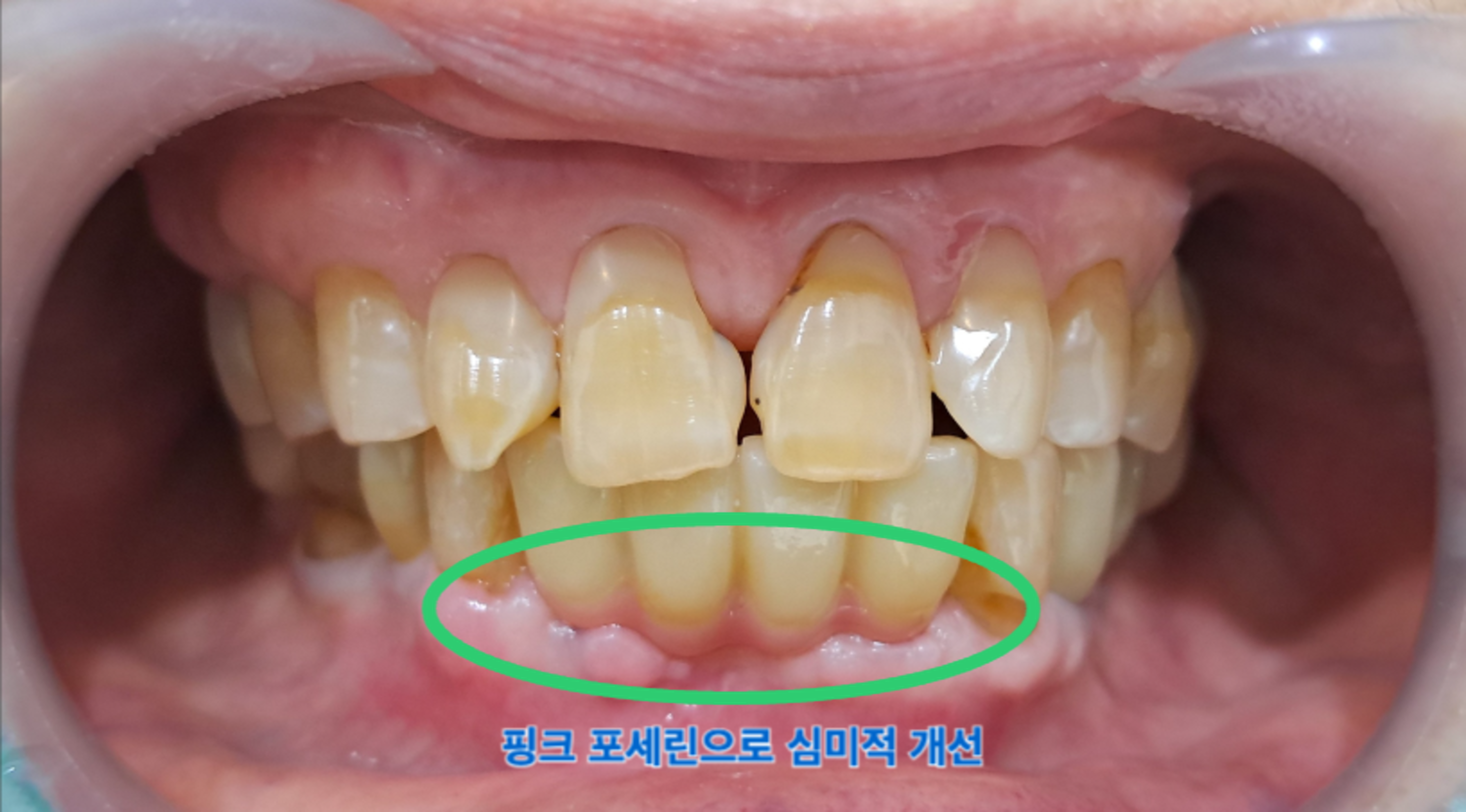 [치료 후] 보철 수복 완료 (치아 길어보이지 않게 핑크 포세린 처리)
