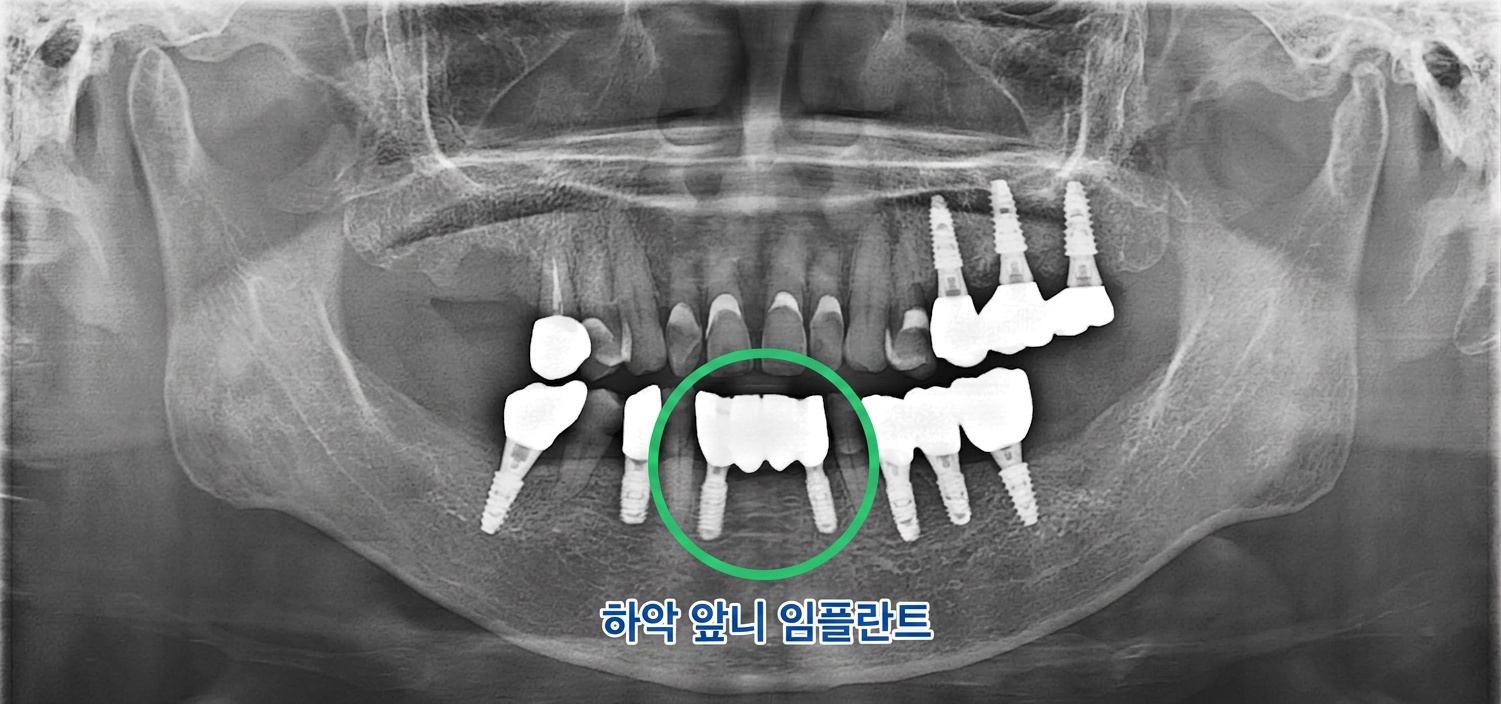 [치료 후] 보철 수복 완료 파노라마