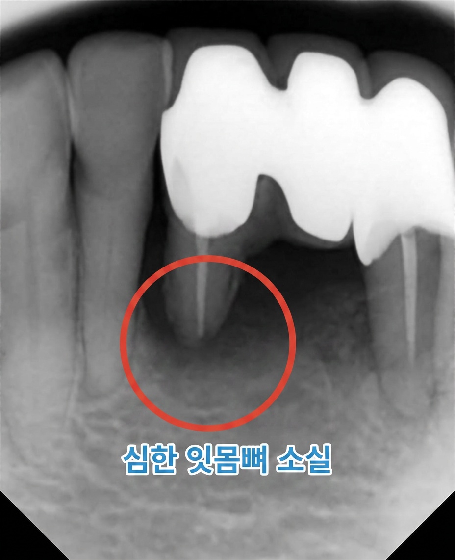초진 pa 하악 전치부 골소실 심하고 치아 흔들림