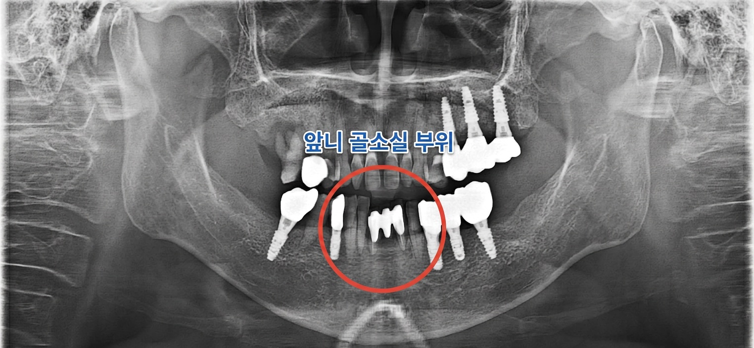 [치료 전] 초진 파노라마 - 하악 전치부 골소실 확인