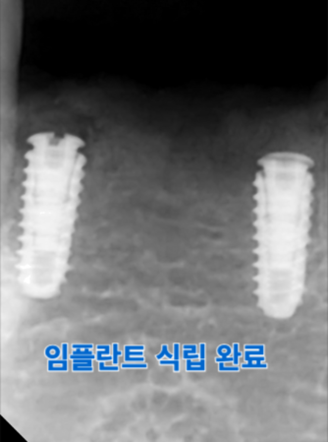 임플란트 식립 된 pa, 유착 잘된모습 확인