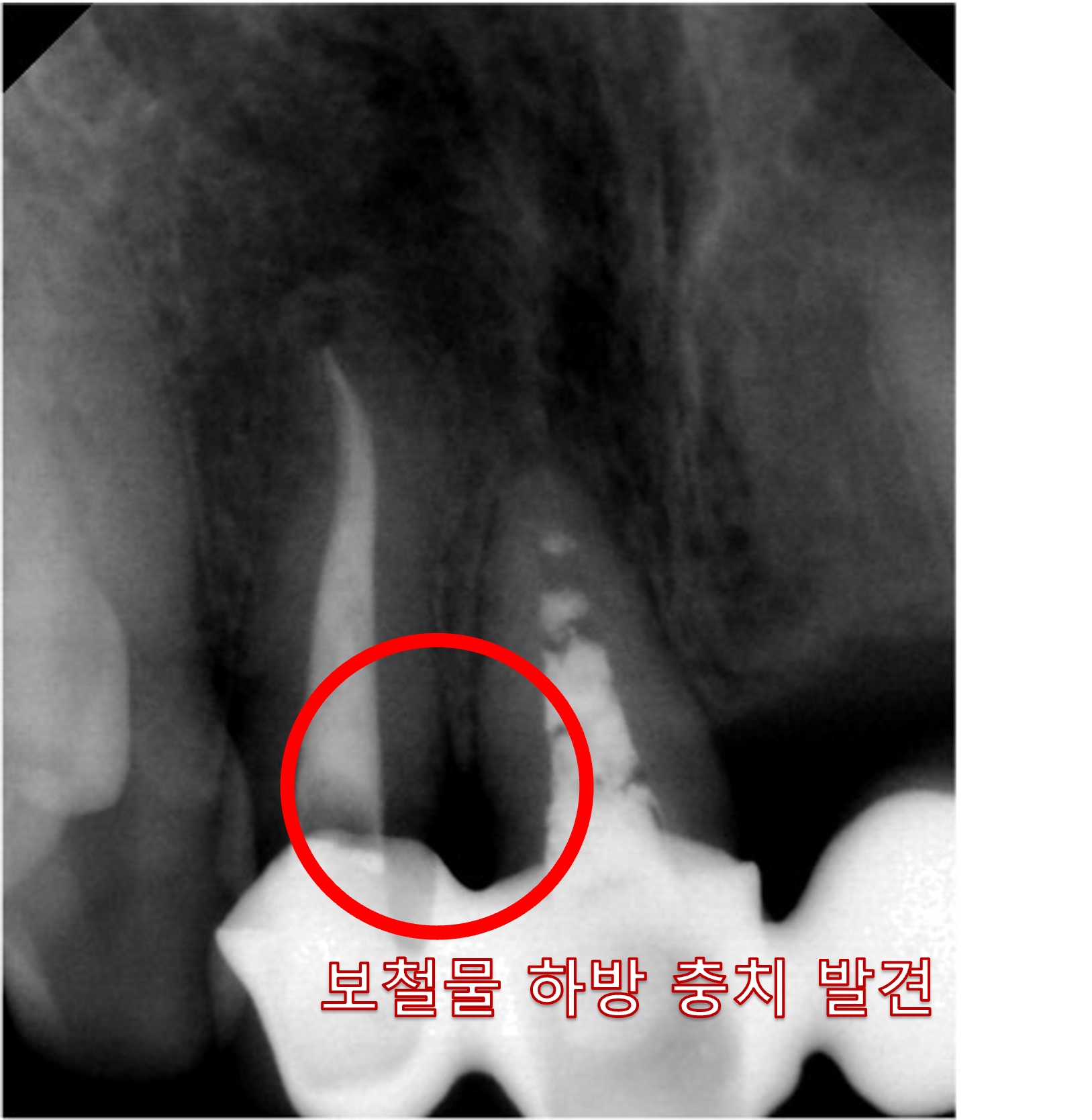 정밀 치근단 촬영 이미지