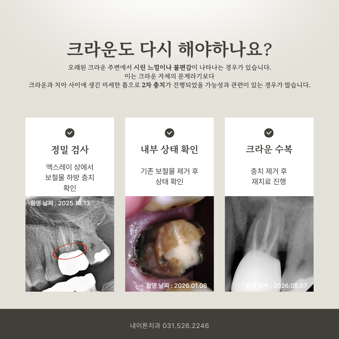 오래된 크라운의 재치료