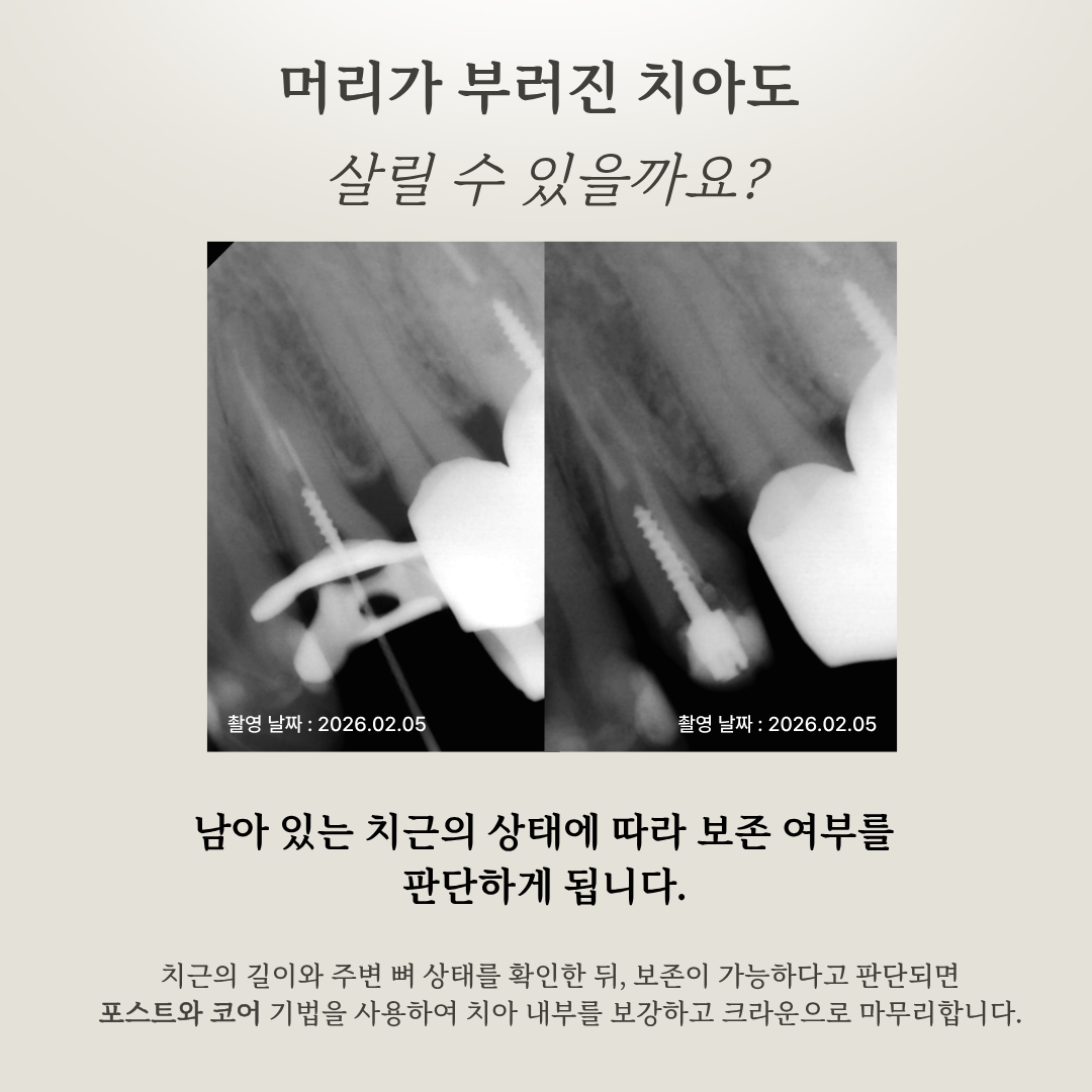 머리가 부러진 치아의 보존 치료