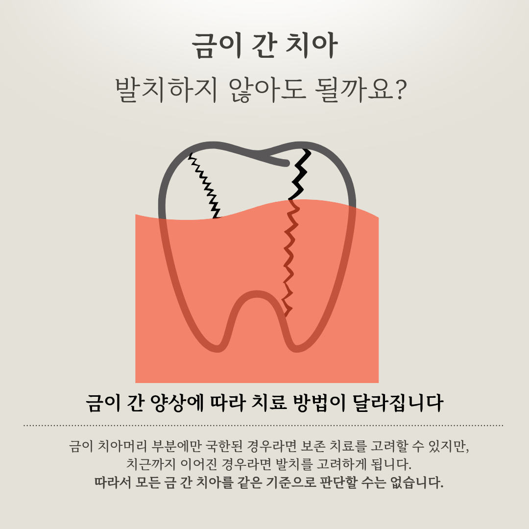 금이 간 치아의 보존 치료