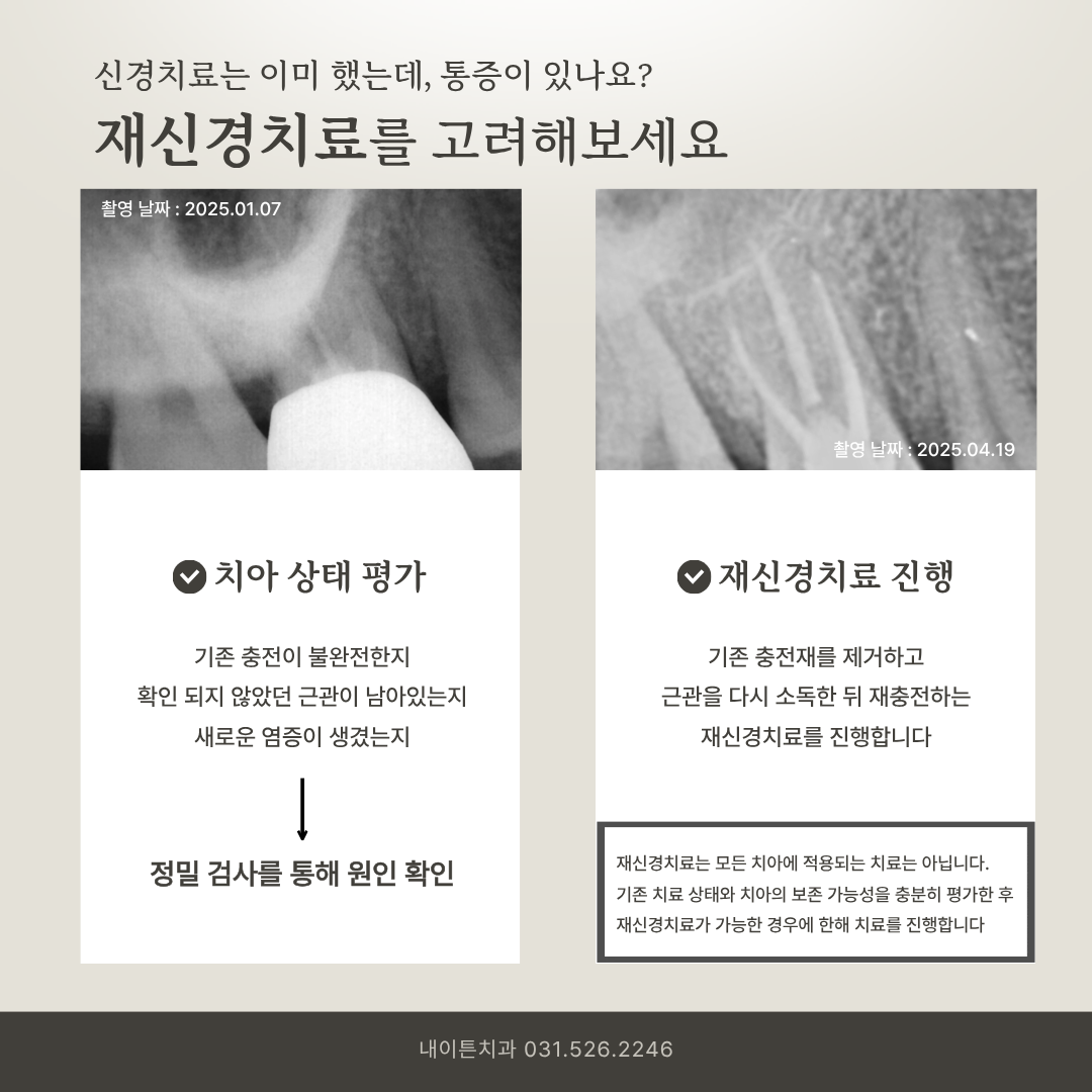 재신경치료