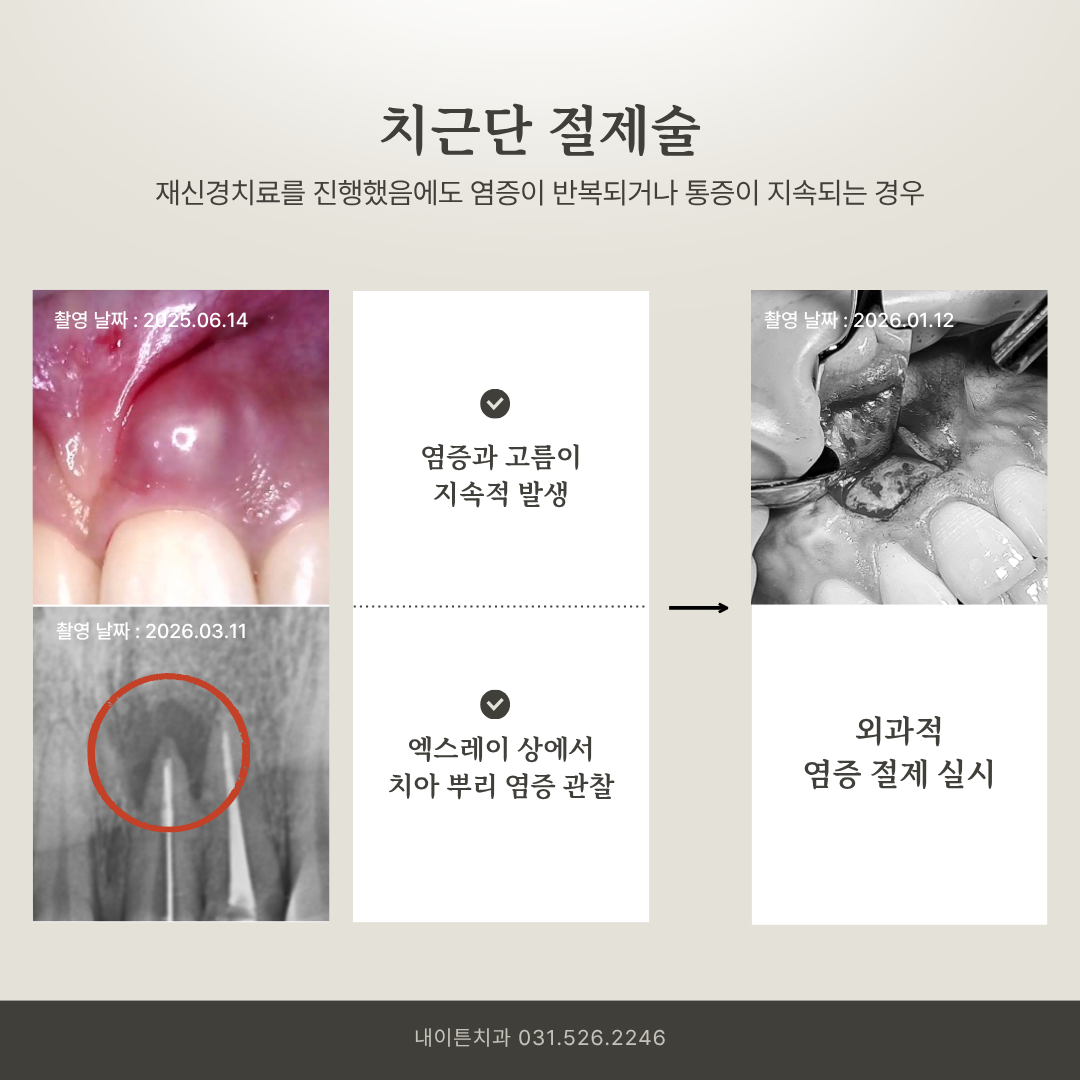 치근단절제술