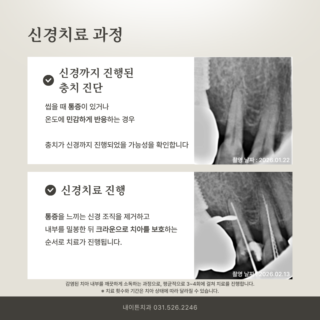 신경치료 과정