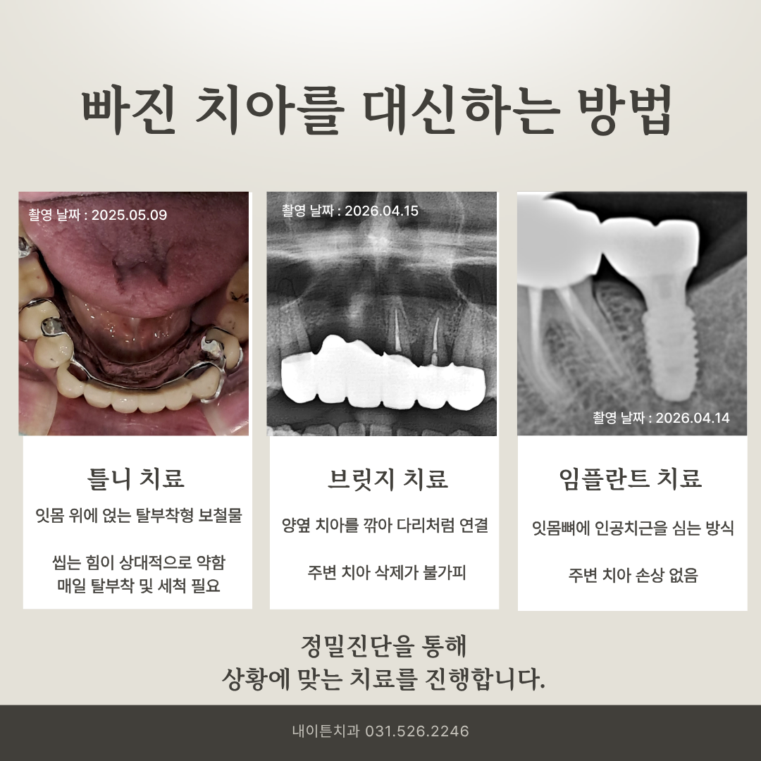 임플란트 치료 안내 이미지