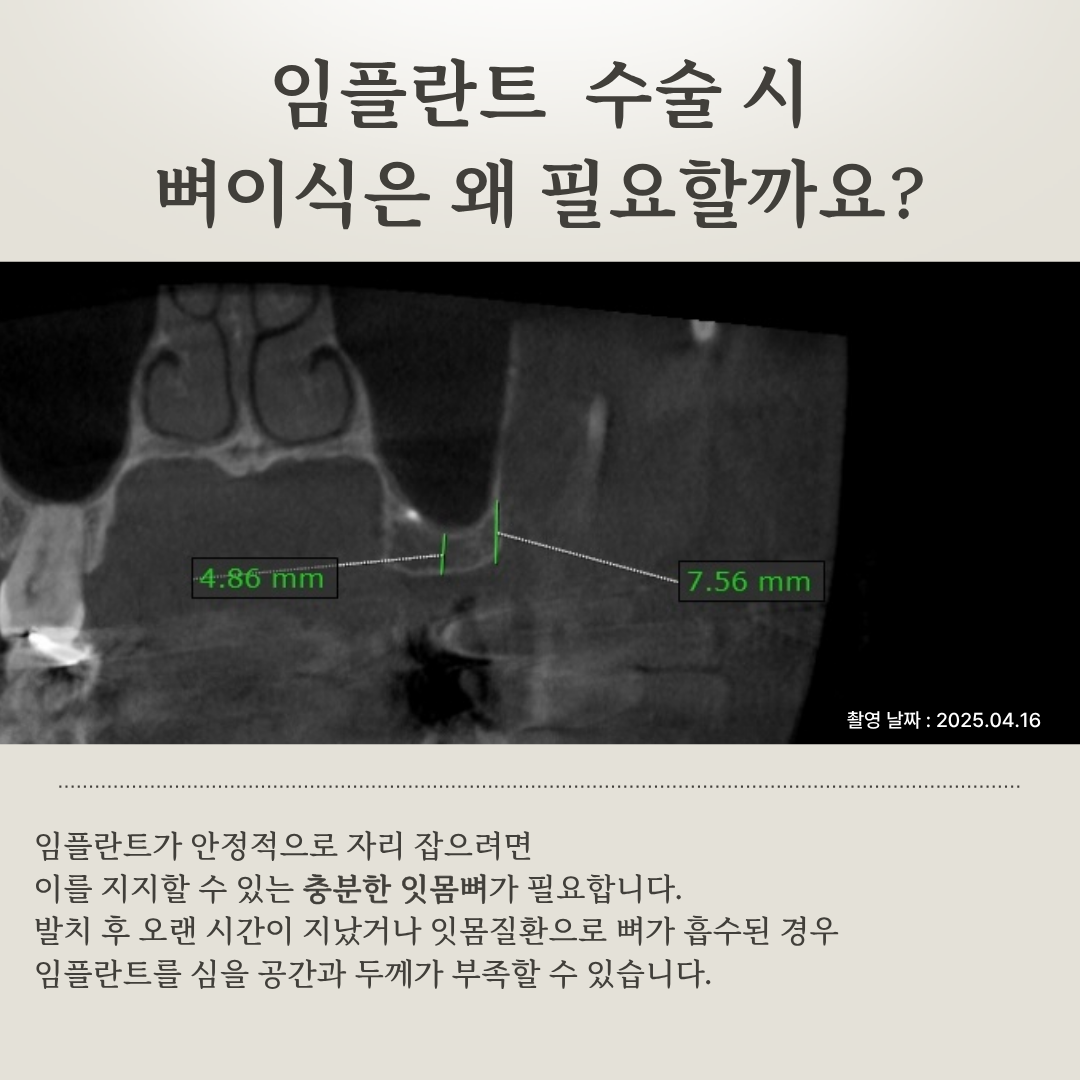 임플란트 치료법 비교 안내