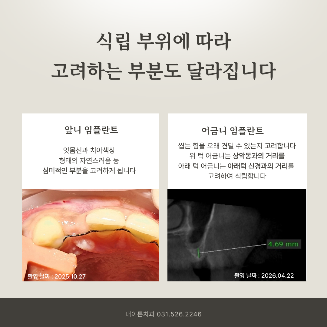 발치 후 임플란트 식립 시기 안내