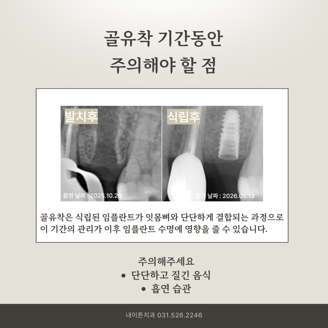 임플란트 식립 후 골유착 기간 주의사항