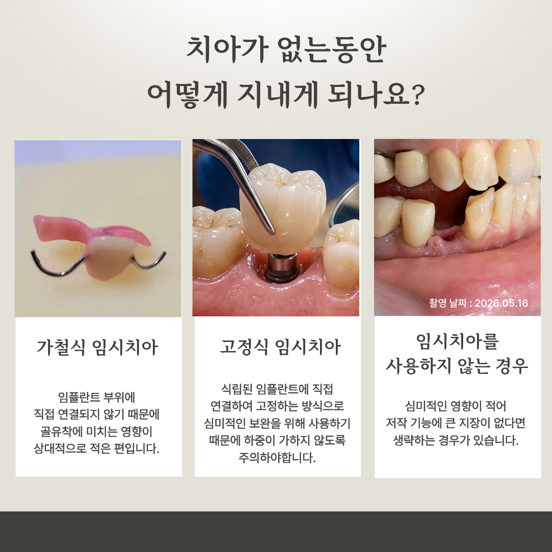 임플란트 치료 중 사용하는 임시치아 안내