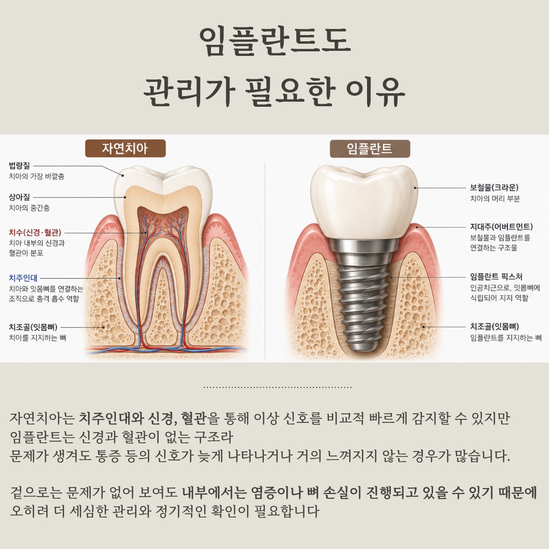 자연치아와 임플란트의 구조적 차이 비교
