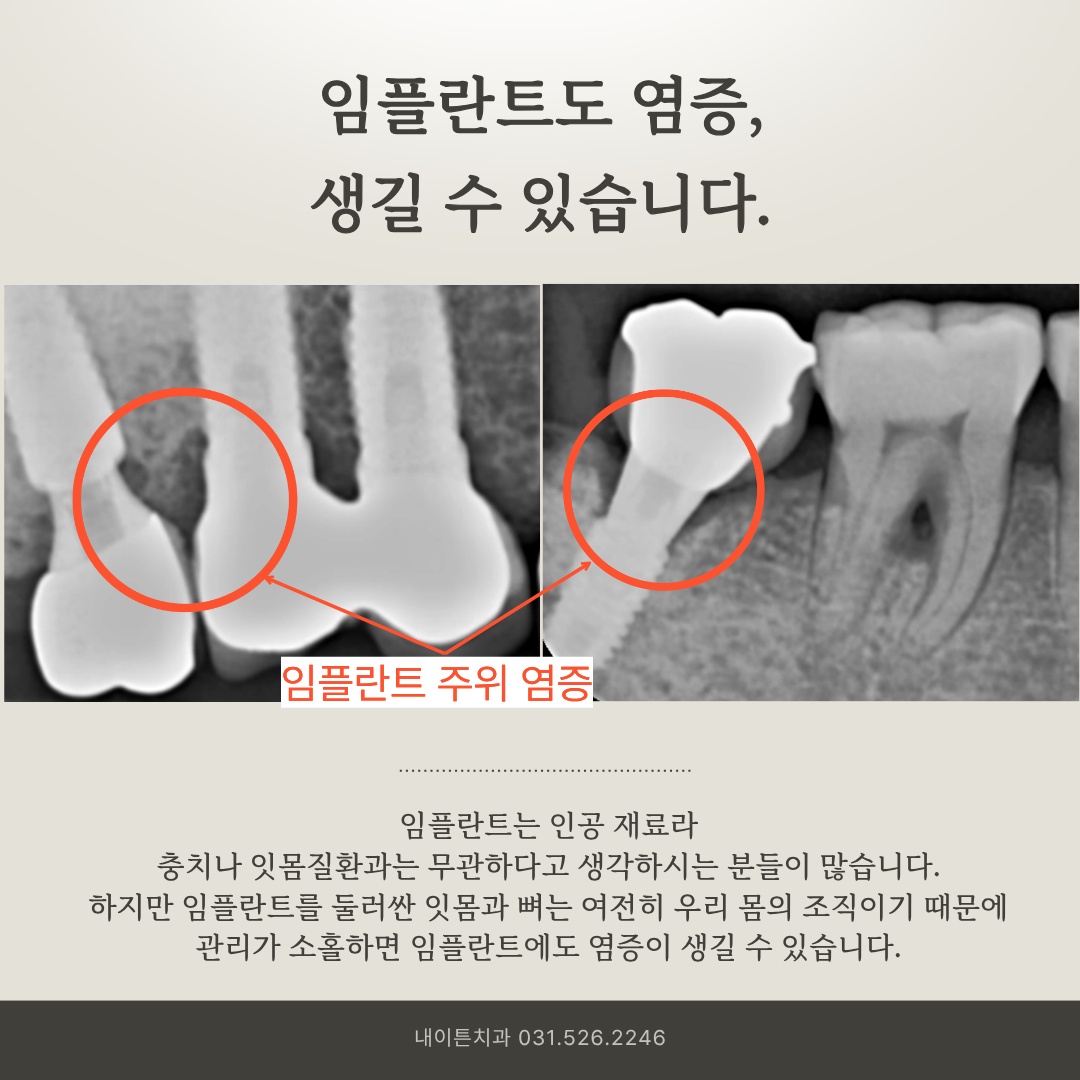 임플란트 식립체 주변 골 흡수 소견