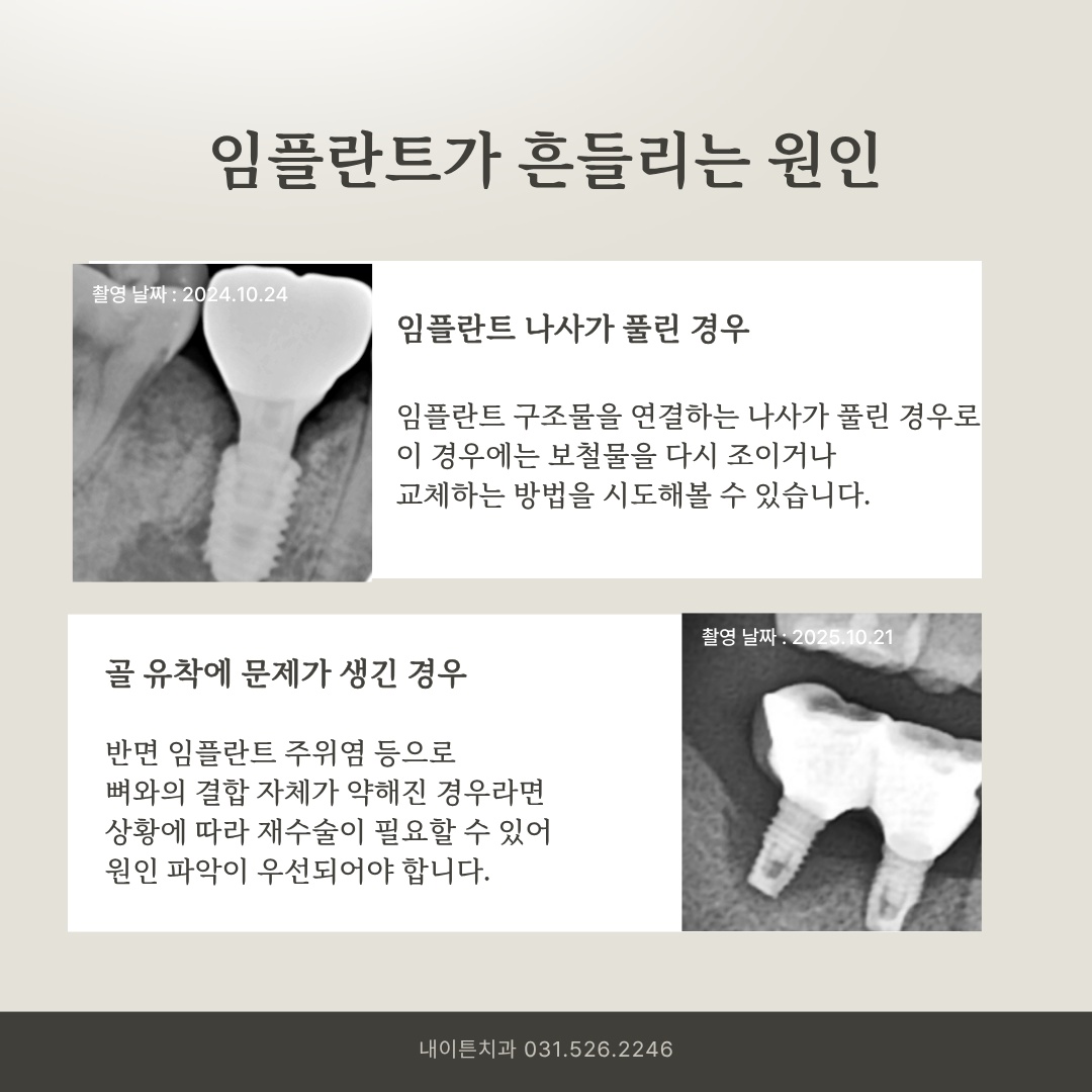 나사 풀림과 임플란트 주위 골 흡수 비교