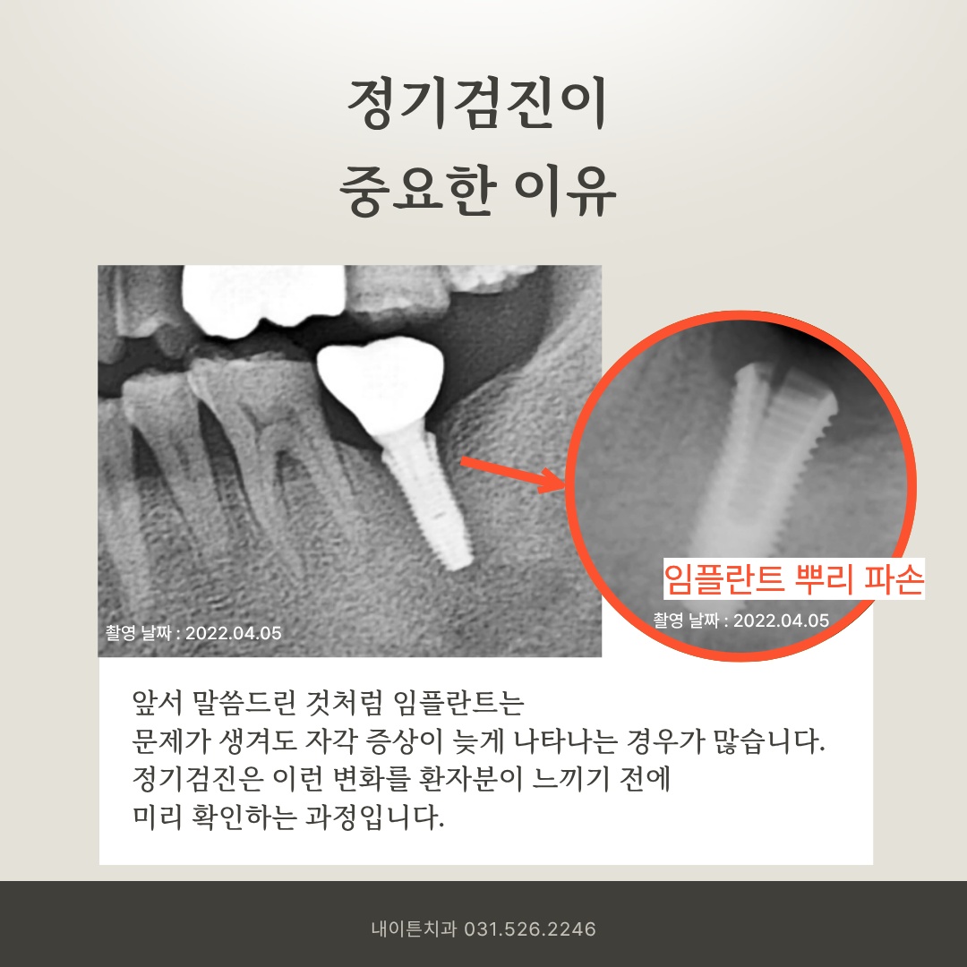 임플란트 픽스처 중간 부위 파절 소견