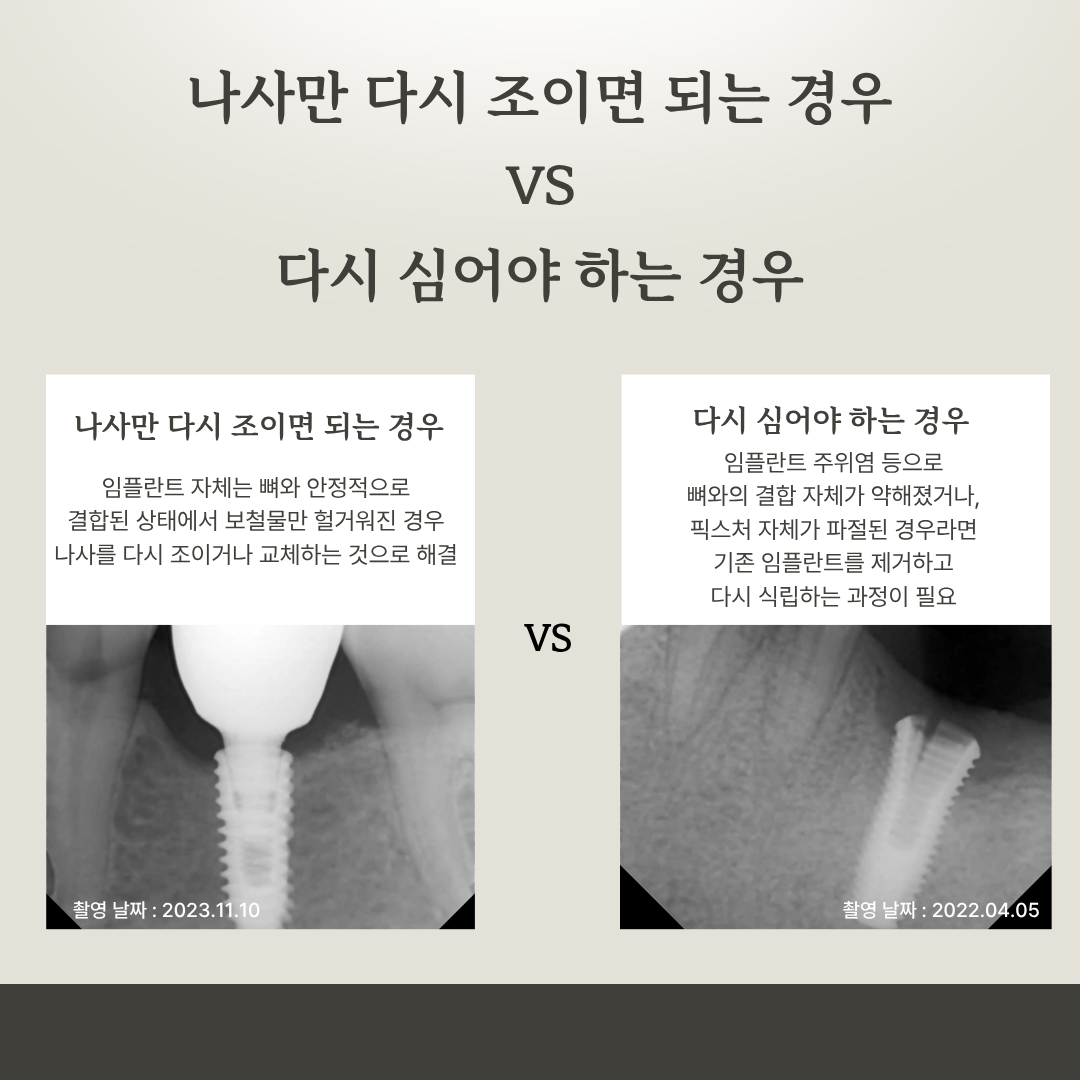 임플란트 흔들림 원인에 따른 치료 차이