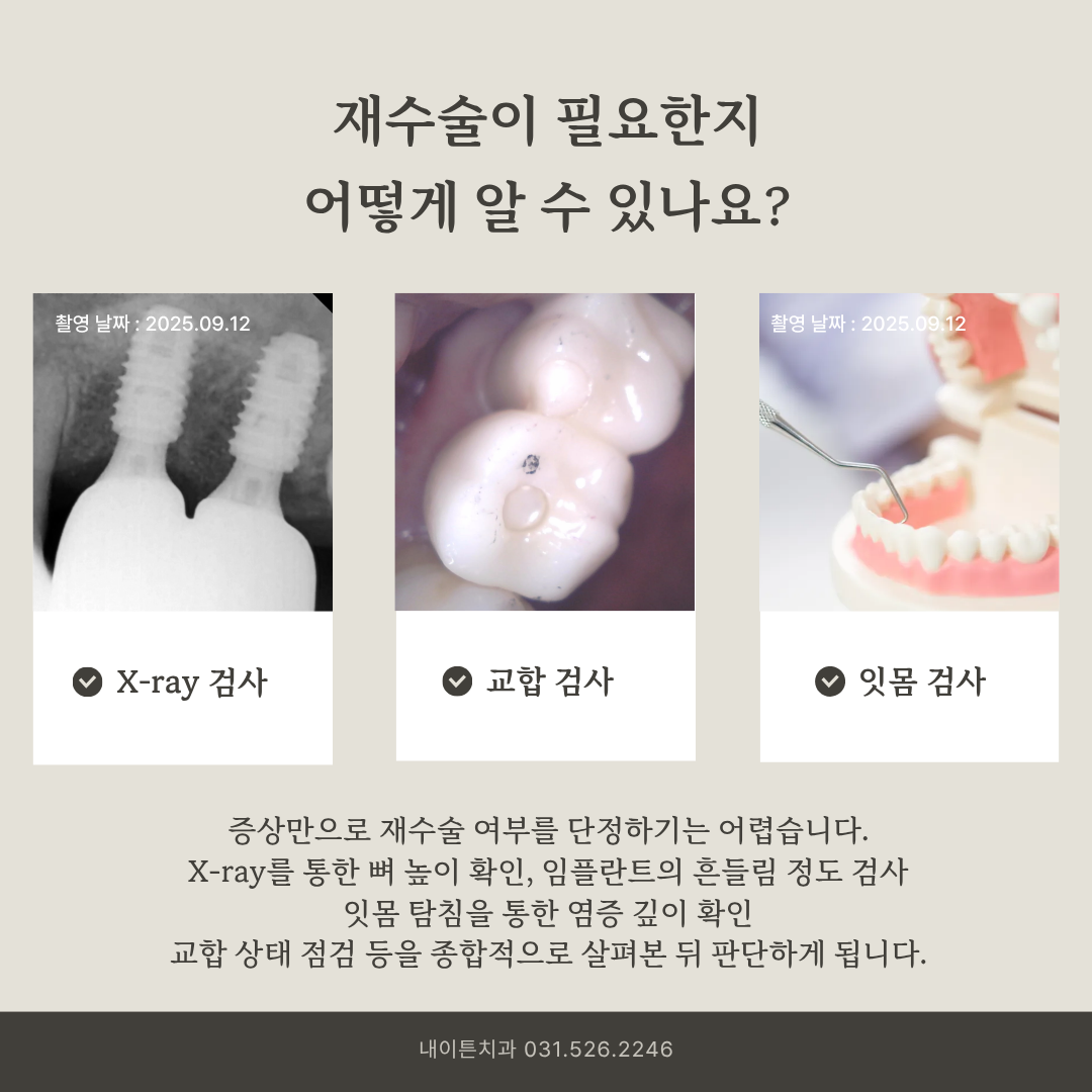 임플란트 재수술 판단을 위한 검사 항목