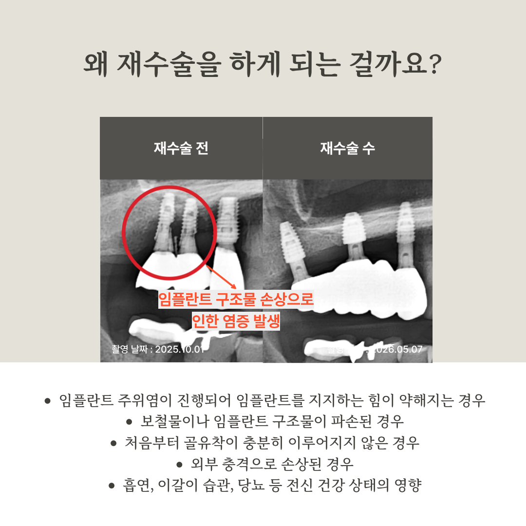 임플란트 재수술로 이어질 수 있는 원인 안내