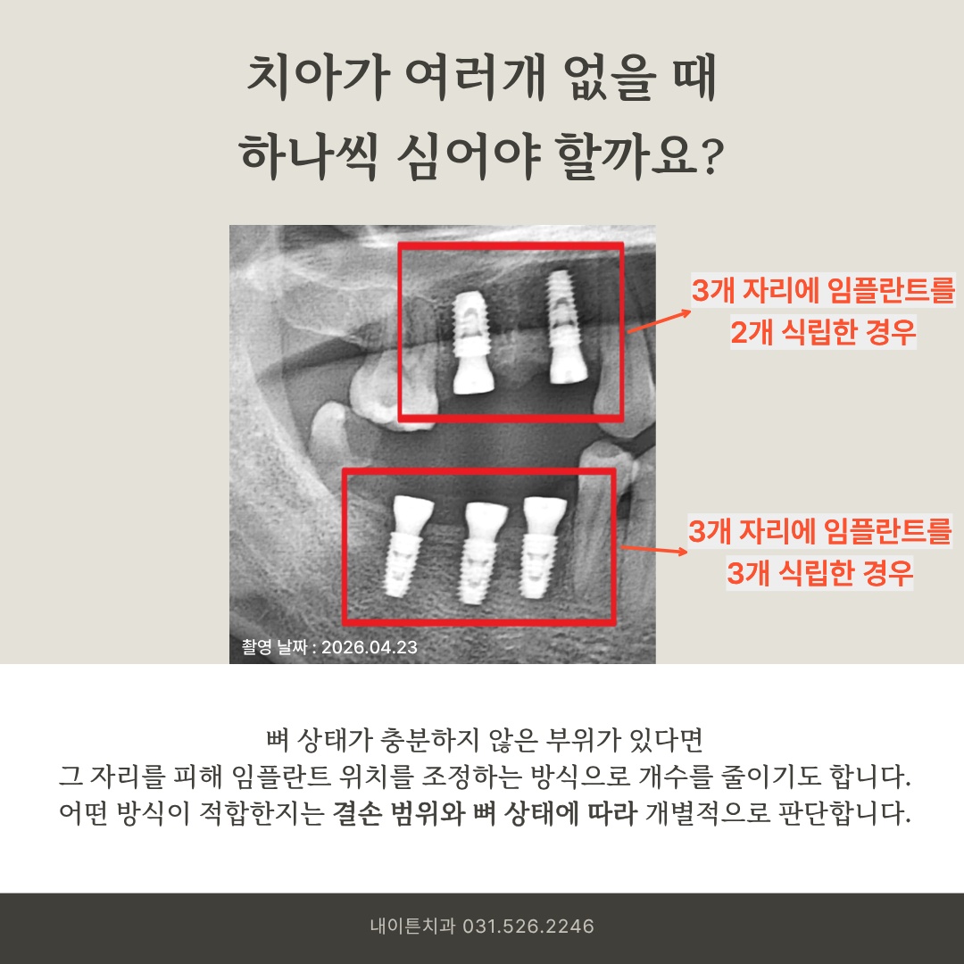 우측 상악 및 하악 구치부 임플란트 식립 소견