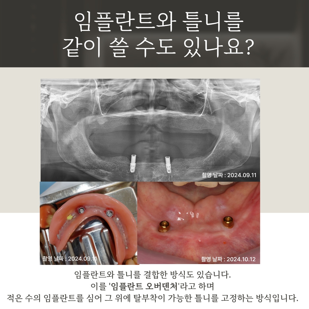 하악 임플란트 오버덴처 장착 소견