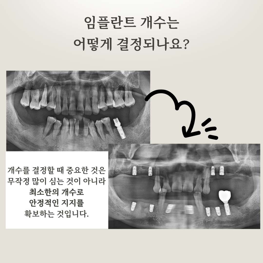 전악 임플란트 재건 파노라마 엑스레이