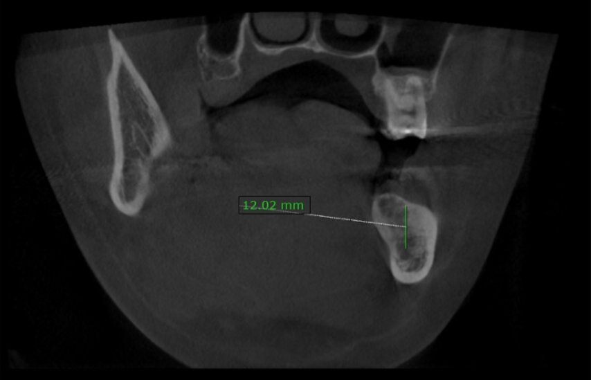 [치료 중] 3D CT 분석 - 하치조신경관 거리 확인