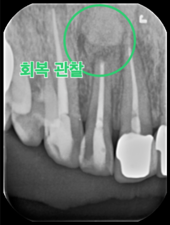 치근단 절제술 후 회복 pa