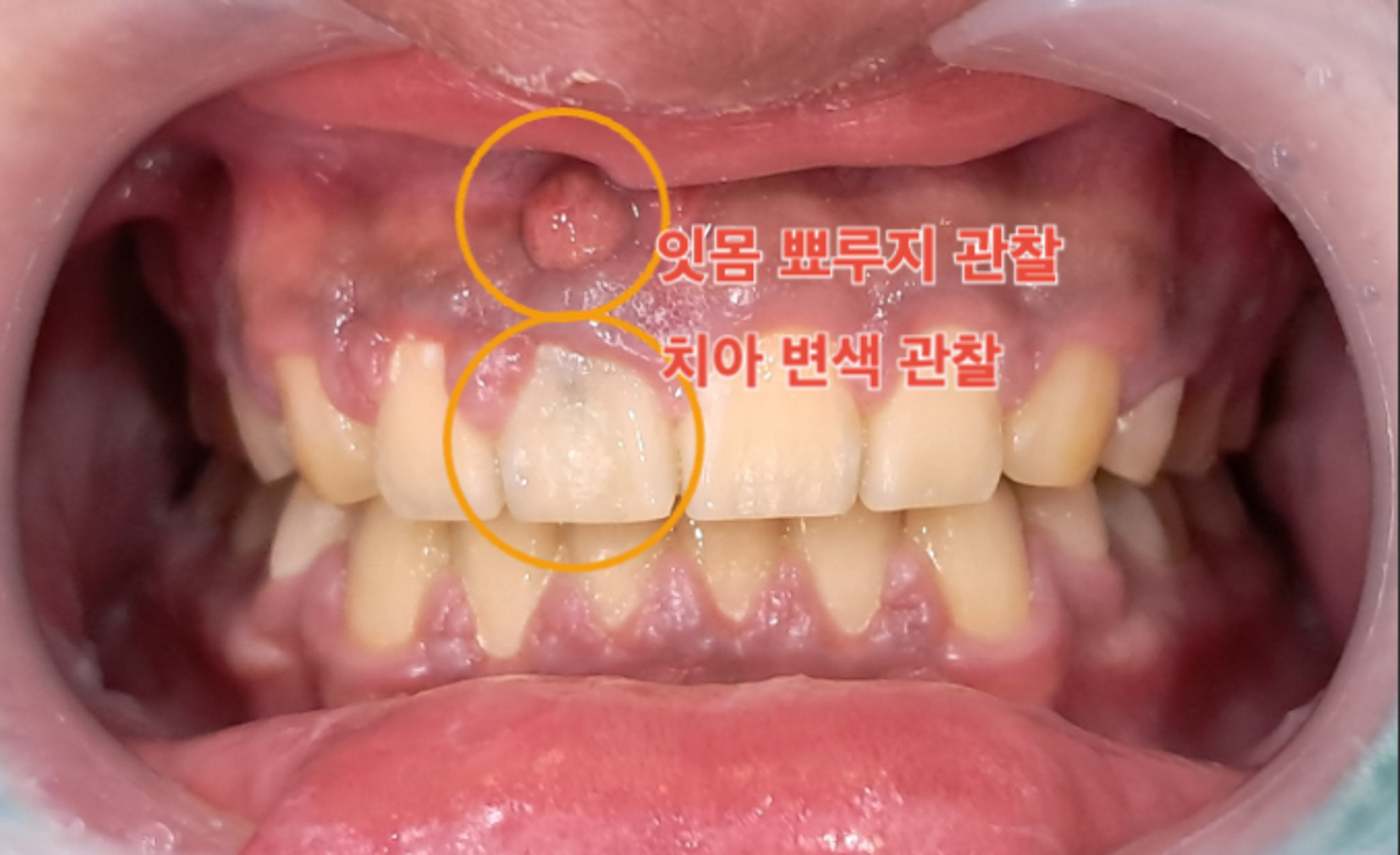 초진 육안 임상사진