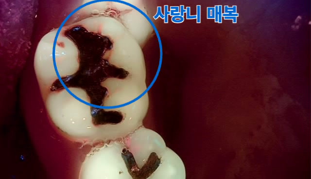 [치료 전] 육안 및 큐레이 포토