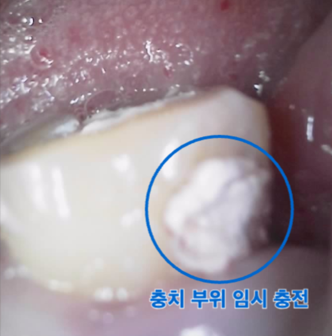 [치료 중] 임시 보강재를 이용한 치아 격리