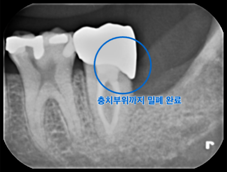 [치료 후] 신경치료 및 지르코니아 크라운 수복 완료