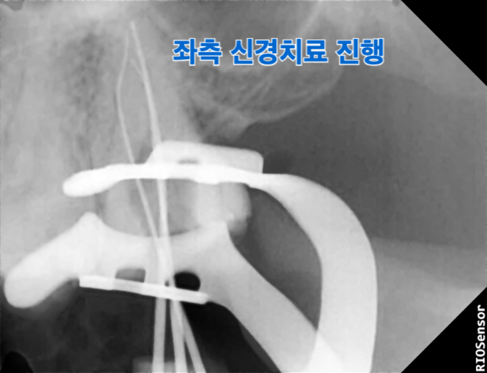 [치료 중] 왼쪽 위 끝 어금니 신경치료 진행