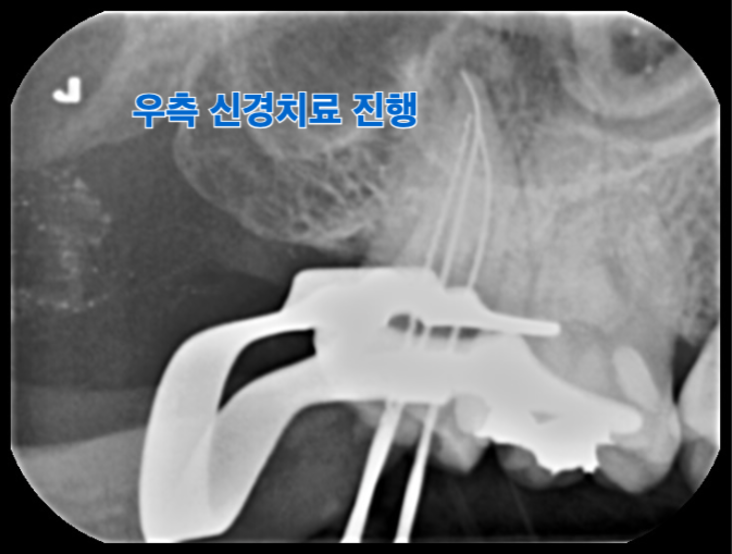 [치료 중] 오른쪽 위 끝 어금니 신경치료 진행