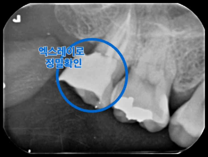 레진 코어 치료 보강 과정