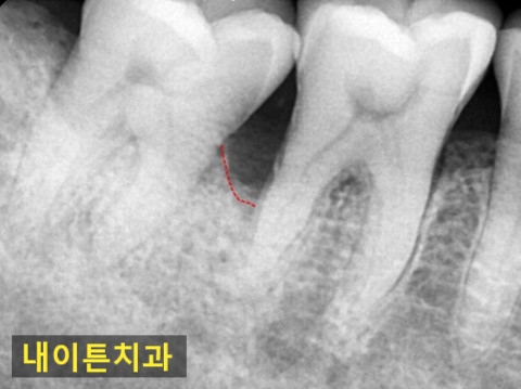 Treatment case image 1