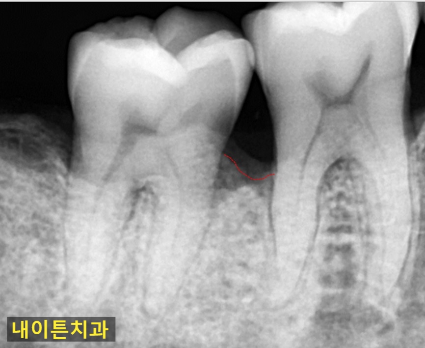 Treatment case image 4