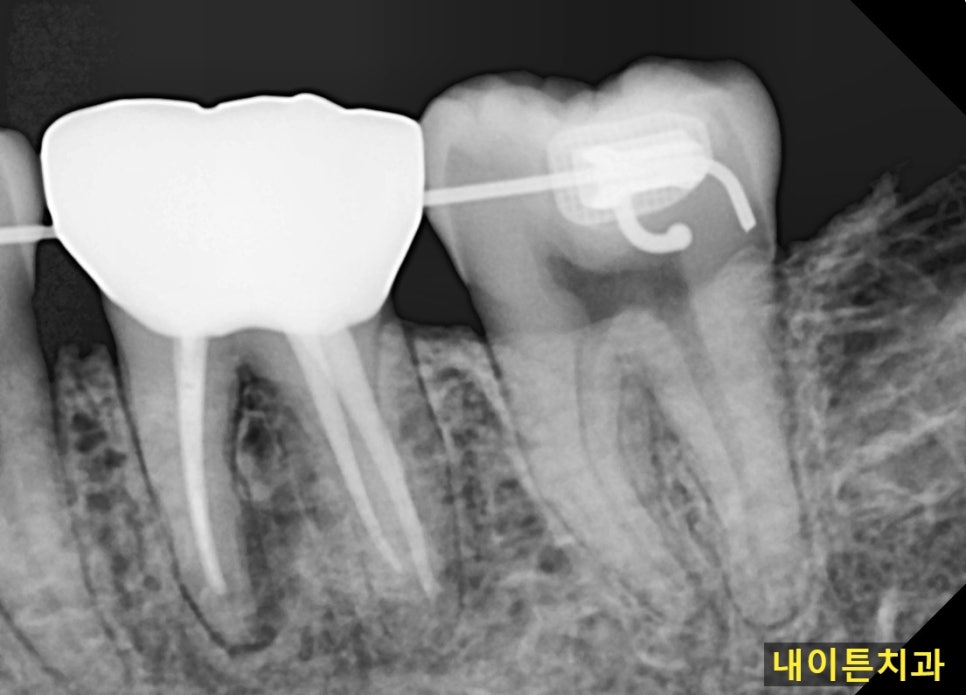 Treatment case image 5